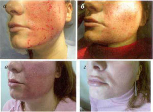 stage of skin recovery after fractional ablation procedure