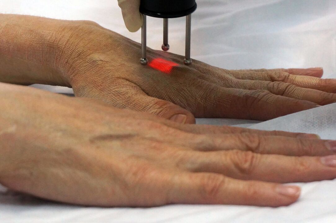 Hand laser rejuvenation with non -ablative methods