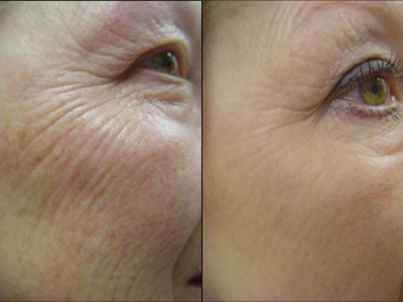 Before and after the laser rejuvenation procedure - significant reduction in wrinkles