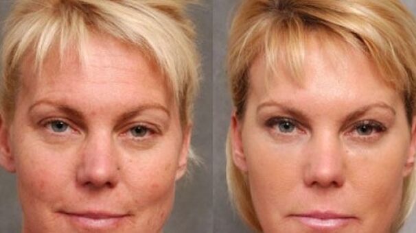 Before and after rejuvenating procedures