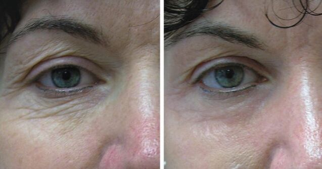 Laser of the skin around the eyes