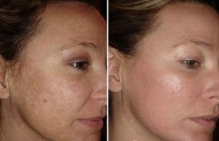 laser facial skin rejuvenation before and after pictures